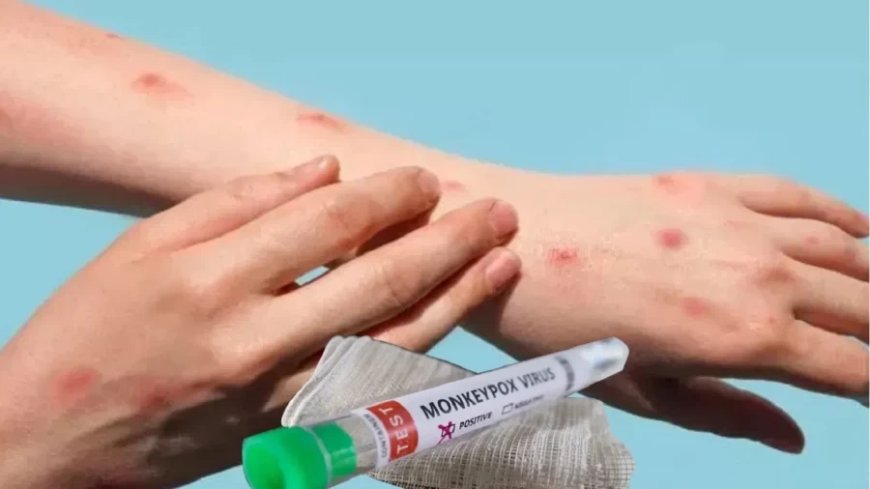 Mpox Case in Kerala: मंकीपॉक्स का देश में दूसरा केस मिला, क्या खतरनाक बन रहा है ये वायरस?